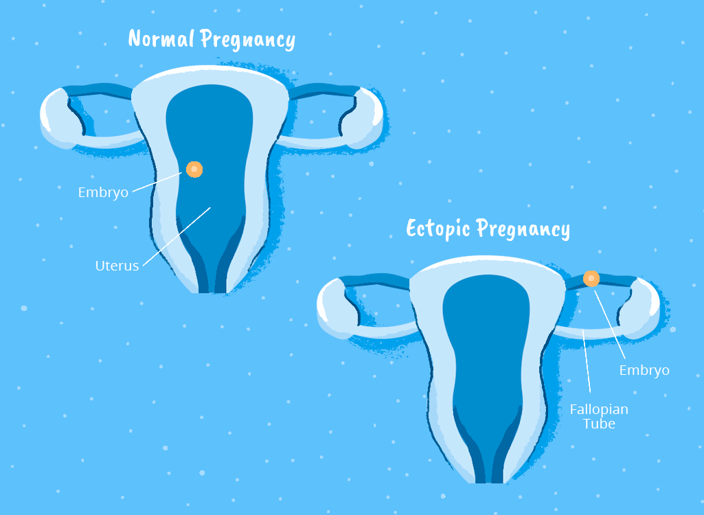 Ectopic Pregnancy – SW