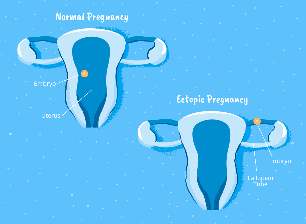 Ectopic Pregnancy – PT