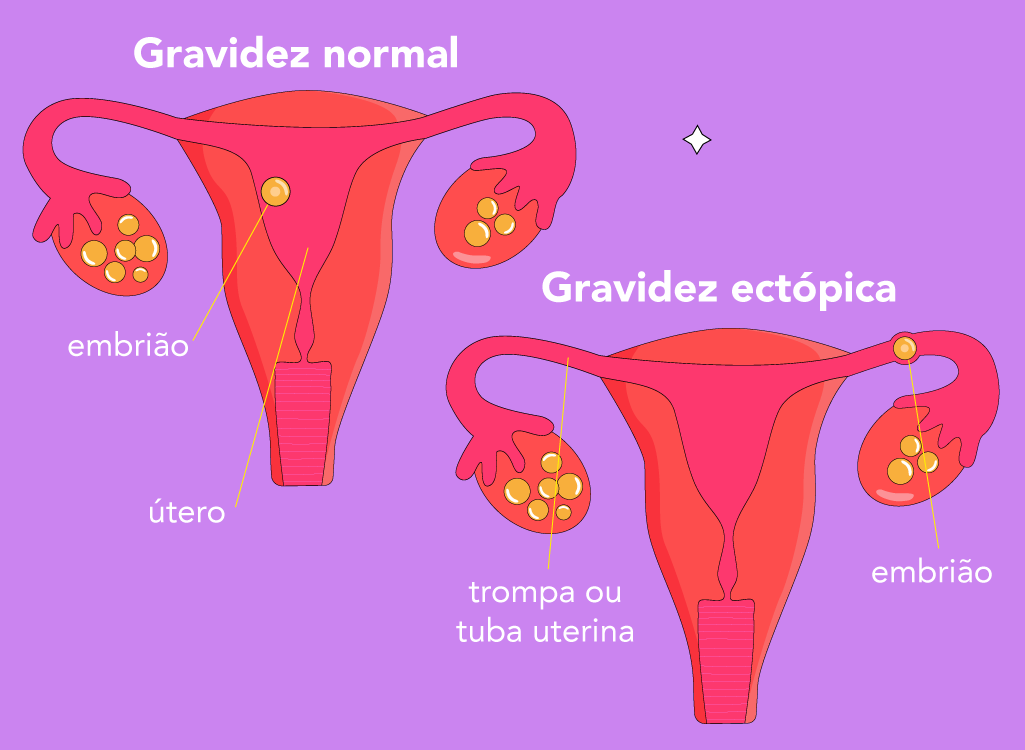 Ectopic Pregnancy – PT