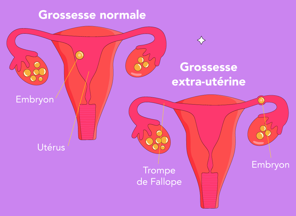 Ectopic Pregnancy – FR